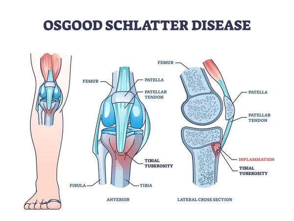 Kondisi penyakit Osgood schlatter dengan nyeri sendi garis luar lutut - Stok Vektor