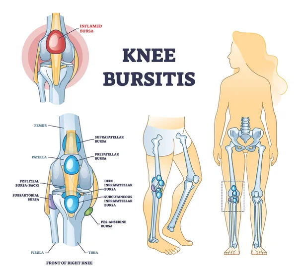 Estado de bursitis de rodilla con bursa llena de líquido en el diagrama del contorno de las articulaciones de las piernas — Vector de stock