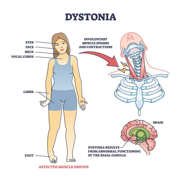 Trastorno de la distonía como espasmos musculares anormales y diagrama de contorno de contracciones — Archivo Imágenes Vectoriales