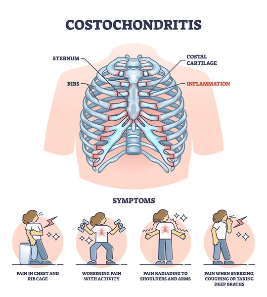 Costokondrit som bröstkorgssmärta eller kostosternalt syndrom konturdiagram — Stock vektor