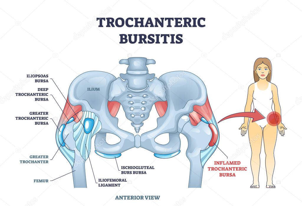 Trochanteric bursitis as bursa inflammation located in hip outline diagram