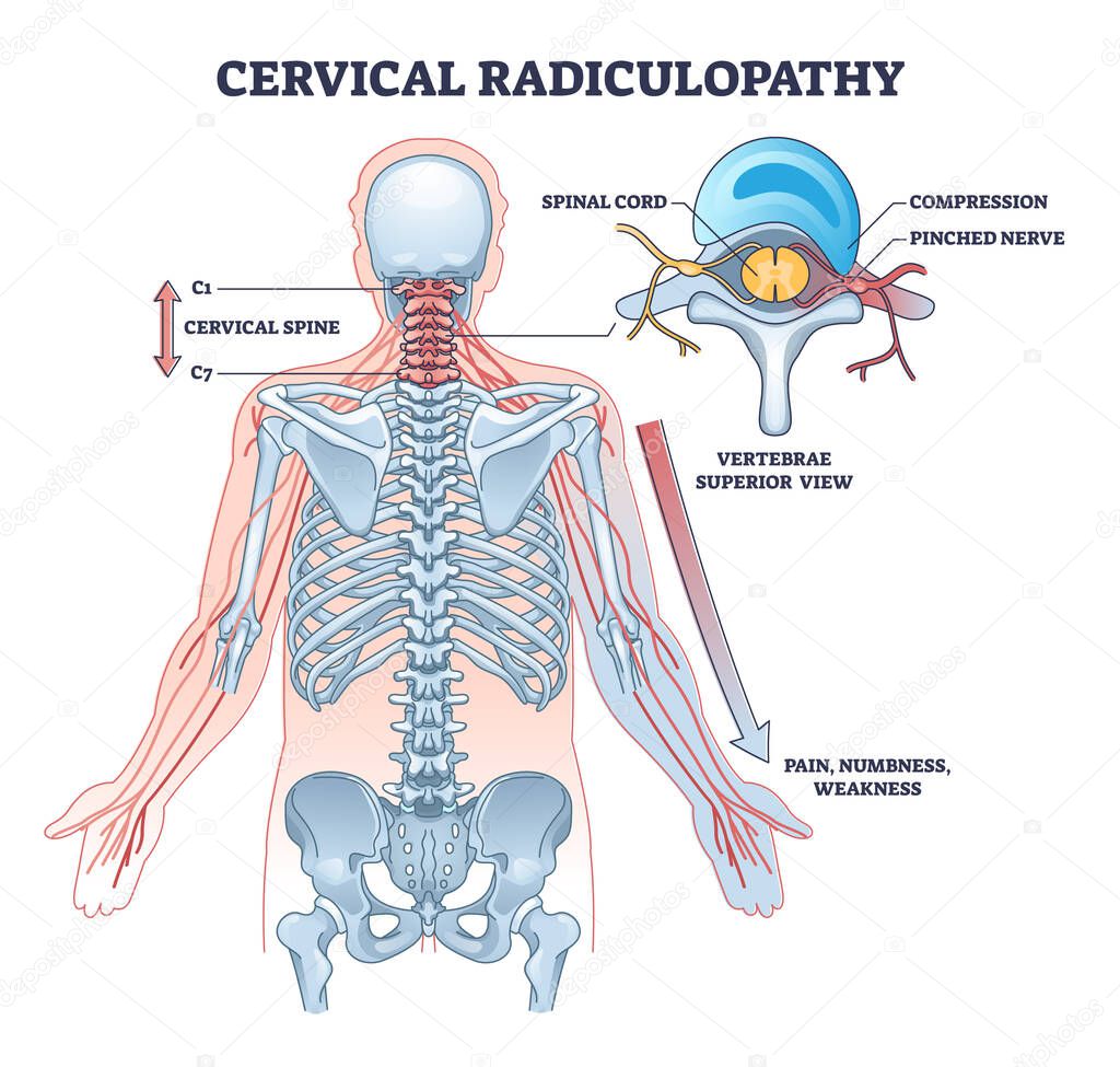 Cervical radiulopathy as painful neck nerve irritation outline diagram