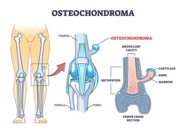 Osteochondroma knee problem as medical bone tumor overgrowth outline diagram clipart