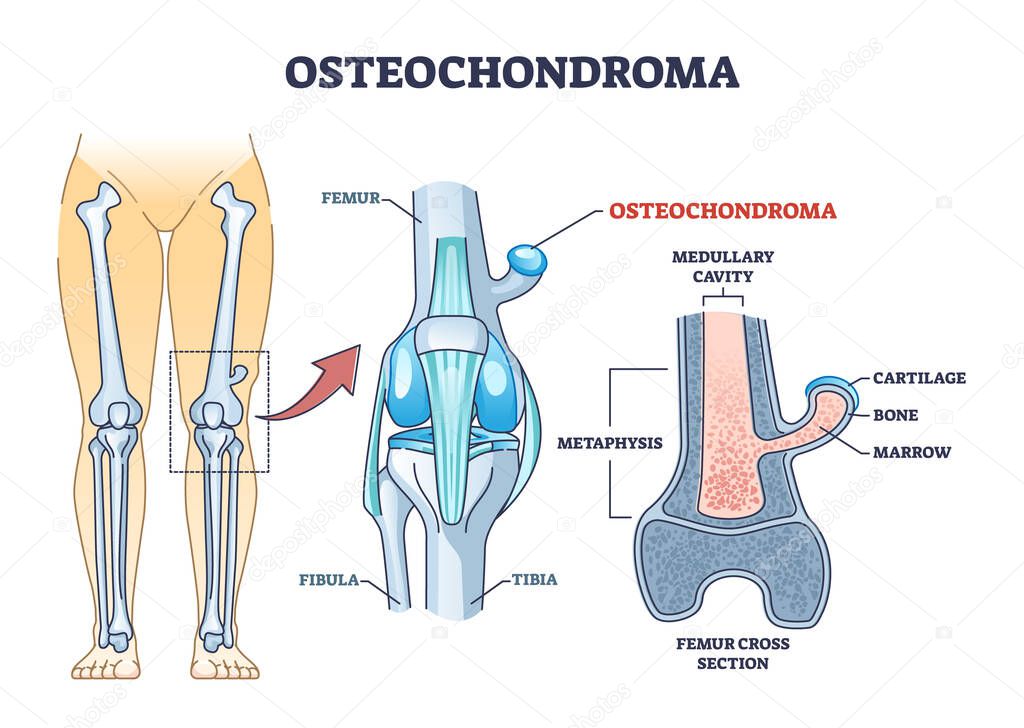 Osteochondroma knee problem as medical bone tumor overgrowth outline diagram