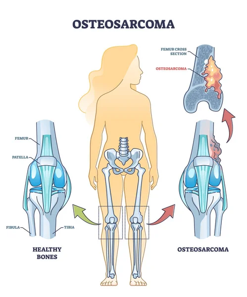 Nowotwór kości kostniakomięsaka jako osteogenny nowotwór szkieletu mięsaka schemat — Wektor stockowy