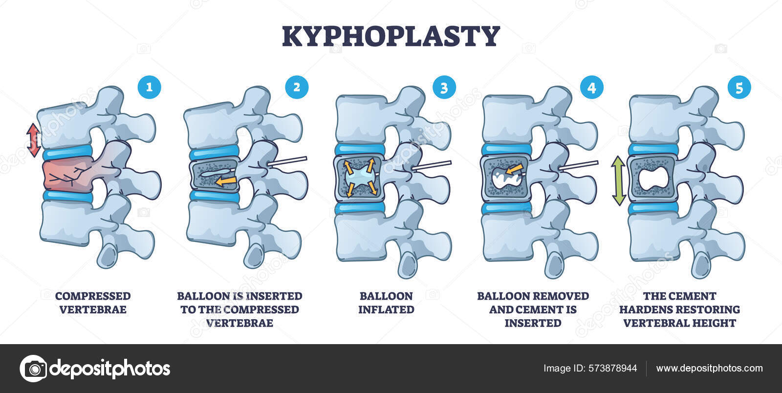 Kyphoplasty Invasive Surgery Spinal Compression Fracture Treatment