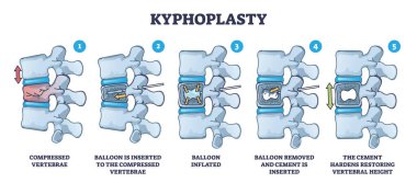 Omurilik sıkıştırma kırığı tedavi şeması için Kyphoplasty invaziv cerrahi. Omurganın yeniden yapılandırılması için balon ve çimento vektör çizimi ile etiketlenmiş tıbbi prosedür.