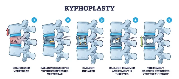 Kyphoplasty Invazív Műtét Gerinckompressziós Törés Kezelés Vázlatos Diagram Címkézett Orvosi — Stock Vector