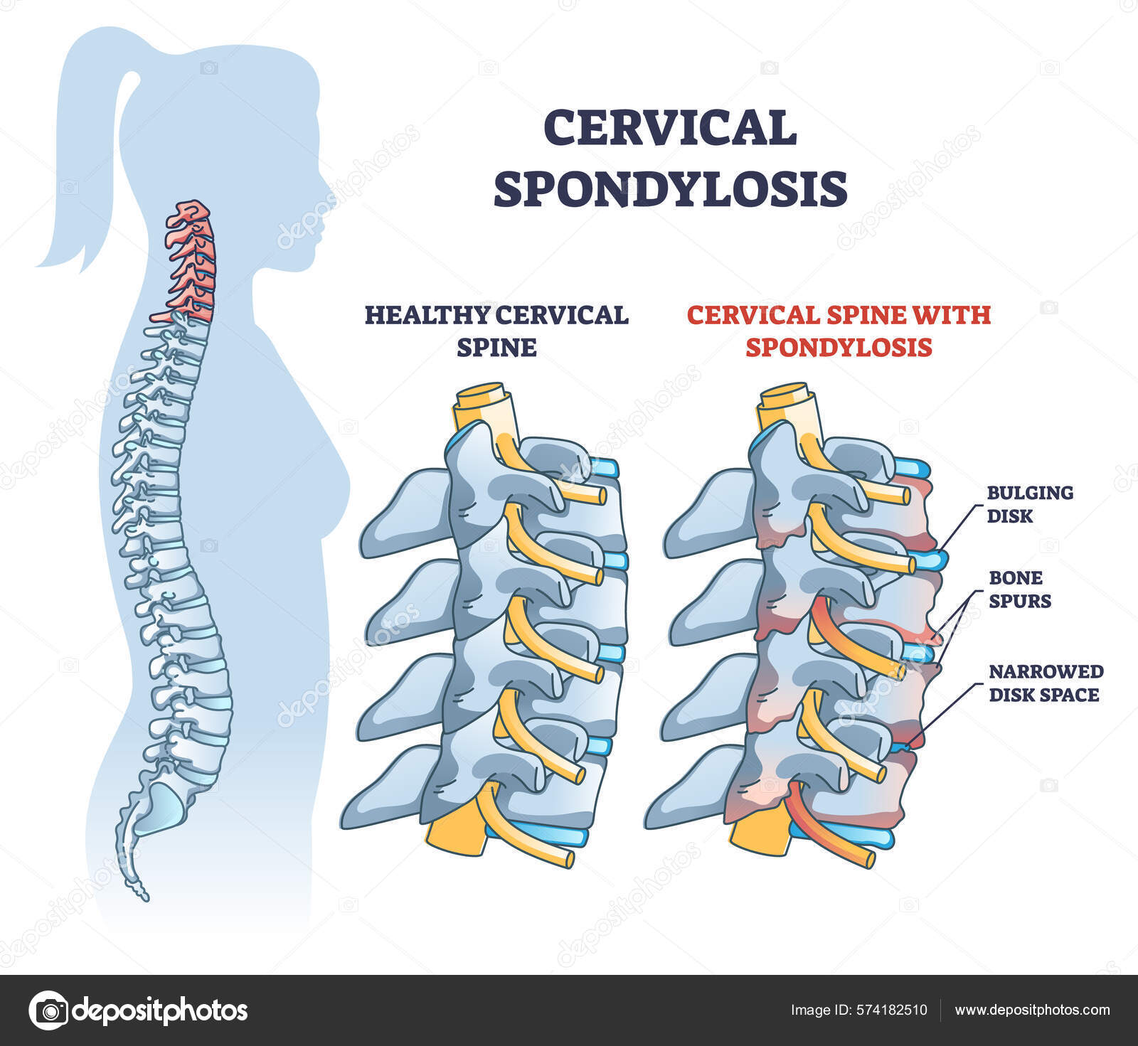 Plaque osseuse de compression vertèbre cervicale – Système II