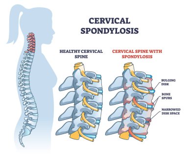 Servikal spondiloz sorunu sağlıklı omurga çizgisi diyagramına kıyasla. İnsan omurgasında şişkinlik, kemik çıkıntıları ve daraltılmış uzay izah vektörü illüstrasyonuna sahip etiketli eğitim şeması.