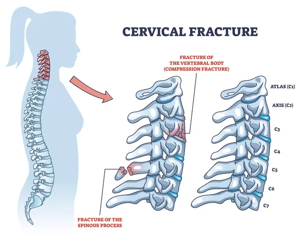 Cervicale Fractuur Menselijke Wervelkolom Wervels Schade Schema Gelabeld Educatief Schema — Stockvector