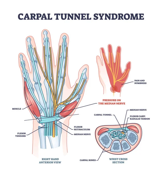 Carpaal Tunnel Syndroom Met Mediane Zenuwdruk Ziekte Schema Gelabelde Educatieve — Stockvector