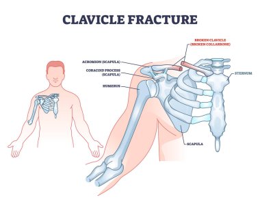 Köprücük kemiği kırığı anatomisi ve kırık omuz köprücük kemiği şeması. Etiketlenmiş eğitim şeması anatomik el ve skapula iskelet ortak vektör çizimi. Akromiyon ve korakoid süreci.