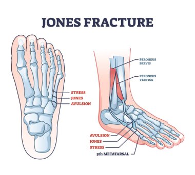 Jones kırığı ve ayak serçe parmağı kemiği kırılmış. Kemik stresi ya da avülsiyon bölümleri ile etiketlenmiş eğitim şeması. Veteriner çizimi. Peroneus brevis ve tertius kas anatomisi