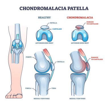 Chondromalacia diz çöküntüsü sağlıklı ana hat diyagramına kıyasla. Kıkırdak sorunu ve anatomik bacak eklem yapı çizimi ile etiketlenmiş diz kapağı dokusu hasarı.