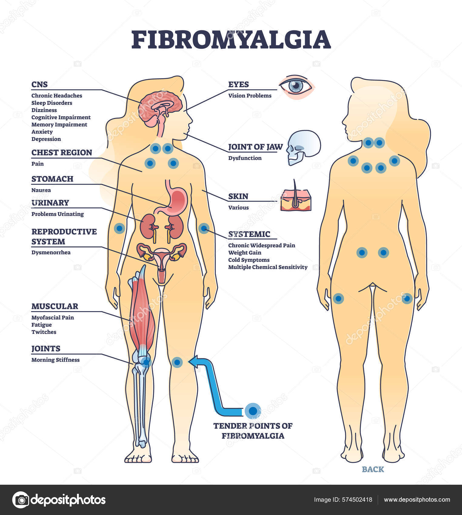 Fibromyalgia Musculoskeletal Pain Disorder Tender Points Outline
