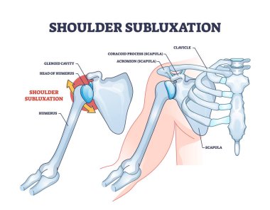Omuz altı çıkıntısı kısmi kol eklem sorunu şeması. Vücut iskeleti anatomisi ve yerinden çıkmış kemik vektör illüstrasyonuyla etiketlenmiş tıbbi şema. Üst vücut travması..