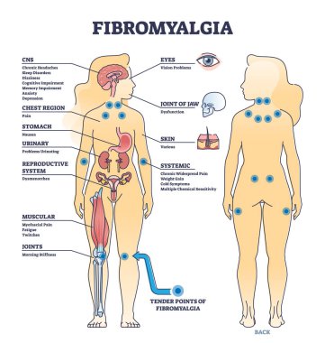 Fibromiyalji, kas-iskelet ağrı bozukluğu. Hassas noktalar çizelgesi. FMS durum vektör illüstrasyonundan kaynaklanan yaygın tıbbi vücut problemleriyle etiketlenmiş eğitim şeması. Belirtiler listesi.