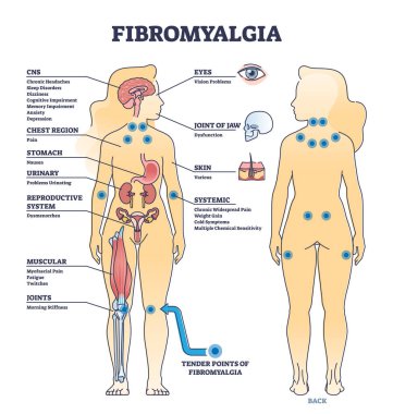 Fibromyalgia as musculoskeletal pain disorder tender points outline diagram. Labeled educational scheme with widespread medical body problems from FMS condition vector illustration. Symptoms list. clipart