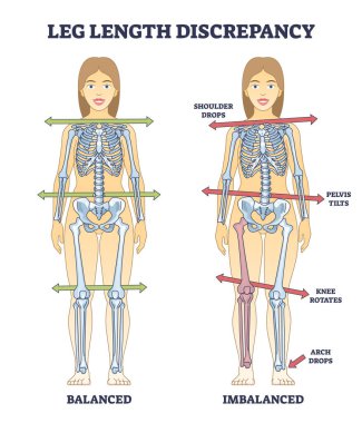 Leg length discrepancy condition with imbalanced skeleton outline diagram. Labeled educational scheme with bones asymmetry and comparison with balanced body vector illustration. Posture symptoms. clipart