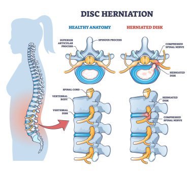 Disk fıtığı ya da omurga sinir sıkışması sağlıklı anatomi şemasına karşı. Üstün eklem süreci ve fıtıklaşmış disk vektör illüstrasyonuyla etiketlenmiş eğitim şeması. Omurga travması..