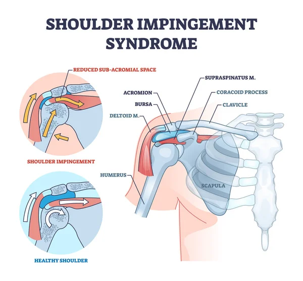 Schulterimpingement Syndrom Durch Reiben Der Rotatorenmanschette Umrissdiagramm Beschriebenes Bildungsschema Mit — Stockvektor