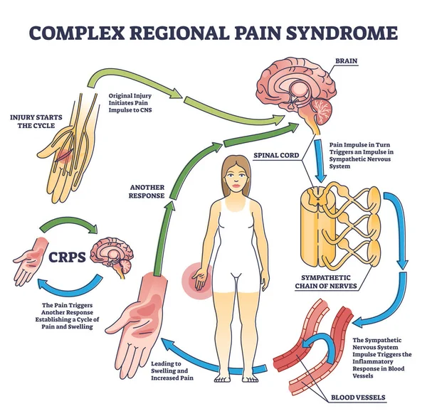 苦痛な状態の輪郭図として複雑な地域性疼痛症候群またはCrps 身体反応ベクトルイラストと教育用腕や脚の腫れサイクルラベル 交感神経系のインパルス — ストックベクタ