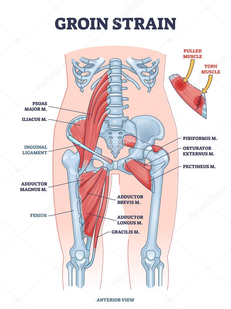Groin strain trauma and pulled or torn muscle injury anatomy outline diagram. Labeled educational medical sport problem explanation with body hips and leg overstretching condition vector illustration.