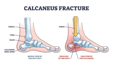 Kalkaneus kırık anatomisi ve kırık topuk kemiği yapısı şeması. Kırık bacak vektör illüstrasyonuna fiziksel kuvvet yönüyle etiketlenmiş eğitim şeması. Sol ayağın orta görünümü