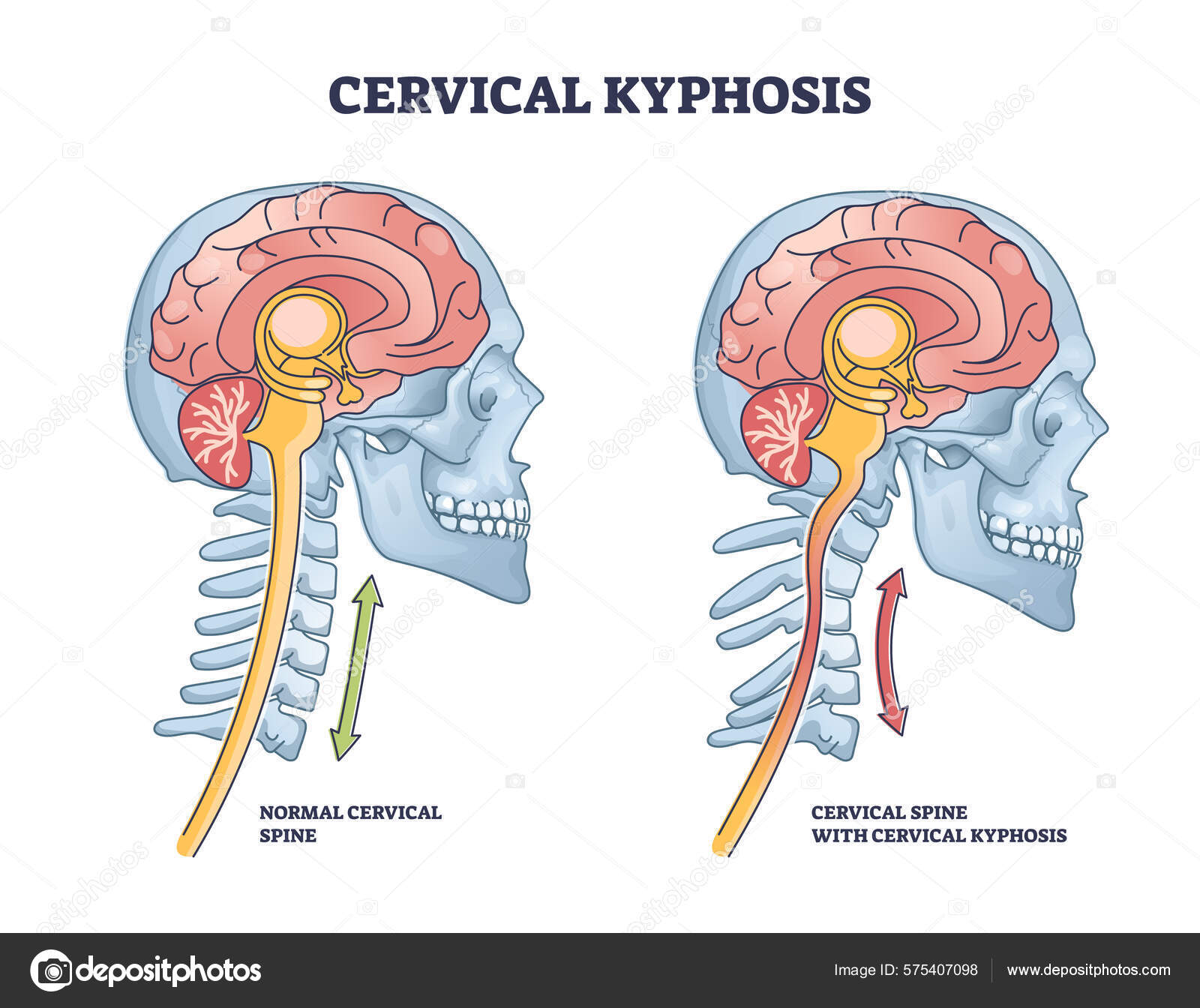 Cervical Kyphosis Condition Spine Neck Curvature Outline Diagram
