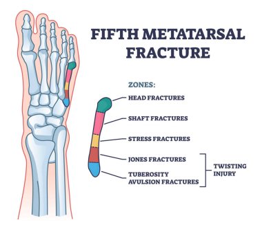 Fifth metatarsal or foot little finger fracture after injury outline diagram. Labeled educational scheme with feet trauma after twisting motion vector illustration. Anatomical skeletal bone zones.