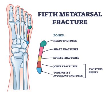 Fifth metatarsal or foot little finger fracture after injury outline diagram. Labeled educational scheme with feet trauma after twisting motion vector illustration. Anatomical skeletal bone zones. clipart