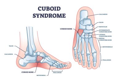 Cuboid syndrome as orthopedic trauma after foot torn injury outline diagram. Labeled educational scheme with feet bone dislocation and free movement vector illustration. Cuboid subluxation problem. clipart