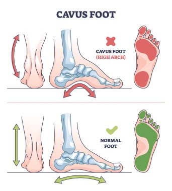 Cavus foot with abnormal high arch condition to feet bones outline diagram. Labeled educational medical deformation compared with healthy model vector illustration. Orthopedic skeletal pathology.