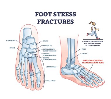 Foot stress fractures as bone cracking trauma or injury outline diagram. Labeled educational scheme with leg skeletal anatomy and orthopedic problem caused by repetitive overuse vector illustration.