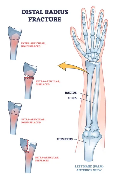 Distal Radius Fracture Broken Arm Bone Types Anatomy Outline Diagram — Archivo Imágenes Vectoriales