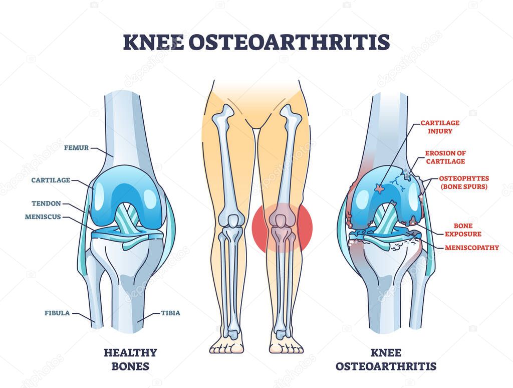 Knee osteoarthritis condition with skeletal bone degeneration outline diagram. Labeled educational scheme with medical orthopedic disease vector illustration. Injury comparison with healthy leg bones.