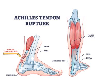 Achilles tendonu acı verici bir yaralanma ve bacak travması diyagramı olarak yırtılır. Etiketlenmiş anatomik şema ile ortopedik problem açıklamalı vektör çizimi. Tıbbi vücut kası durumu.