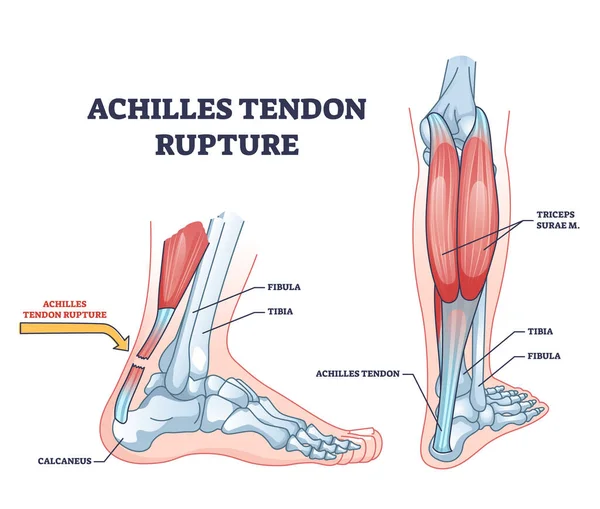 Achilles Tendon Rupture Painful Injury Leg Trauma Outline Diagram Labeled — Stockvektor