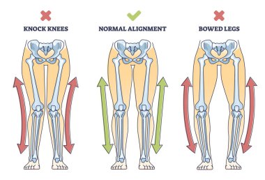 Bowed legs syndrome with normal and knock legs comparison outline diagram. Labeled educational physical defect with outward bending and knees does not touch vector illustration. Anatomical explanation