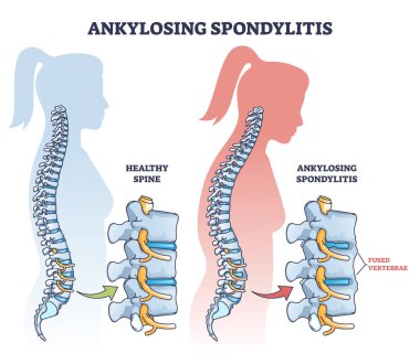 Ankylosing spondylitis as inflammatory spine bone disease outline diagram. Labeled educational anatomical comparison with healthy and damaged vertebrae vector illustration. Fused skeletal back parts. clipart