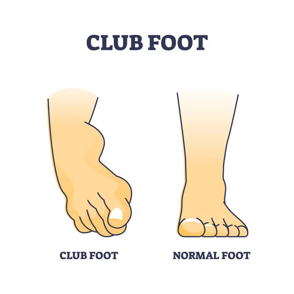 Club Foot Talipes Baby Feet Turn Outline Diagram Labeled Educational — Stockvektor