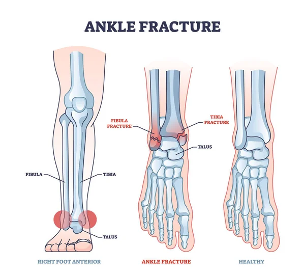 Ankle Fracture Right Foot Anterior Trauma Medical View Outline Diagram — ストックベクタ