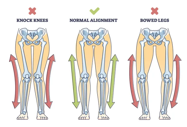 Bowed Legs Syndrome Normal Knock Legs Comparison Outline Diagram Labeled — 스톡 벡터