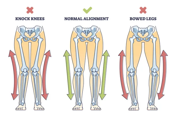 Bowed Legs Syndrome Normal Knock Legs Comparison Outline Diagram Labeled — Stok Vektör