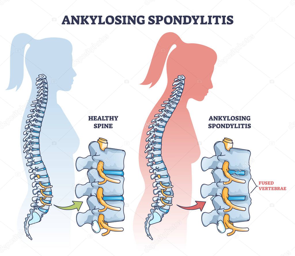 Ankylosing spondylitis as inflammatory spine bone disease outline diagram. Labeled educational anatomical comparison with healthy and damaged vertebrae vector illustration. Fused skeletal back parts.