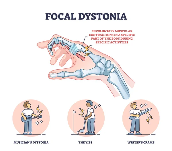 Fokální Dystonie Jako Schéma Anatomických Neurologických Poruch Svalů Označené Vzdělávací — Stockový vektor