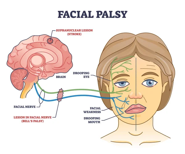 Facial Palsy Muscles Weakness Because Nerve Damage Outline Diagram Labeled — 图库矢量图片