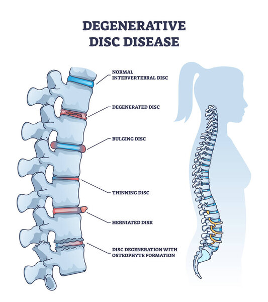 Degenerative disc disease with spine and vertebra trauma outline diagram. Labeled educational normal intervertebral, degenerated, bulging, thinning and herniated problem example vector illustration.