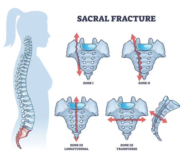 Sacral Fracture Backbone Skeletal Trauma Injury Types Outline Diagram Labeled — Vettoriale Stock